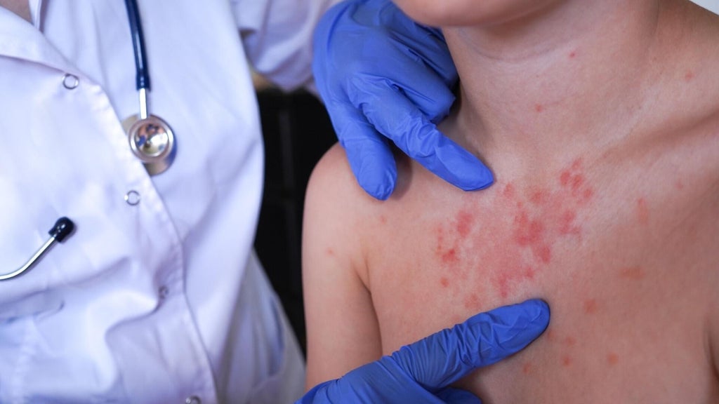 Minnesota's 80 measles cases this year are the most since 1990, health officials say — Edina Health news